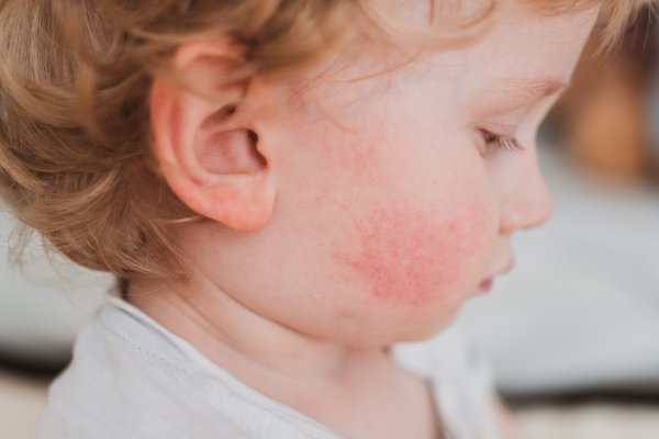 What Are the Effective Home Remedies for Managing Eczema Flare-Ups?